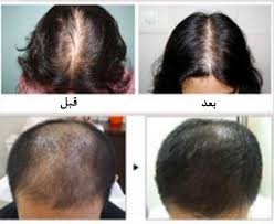 تبلیغات کاذب کاهش ریزش مو یا رویش مجدد: داروی قطعی نداریم/ 11 راهکار بهداشتی برای جلوگیری از افزایش ریزش موی سر